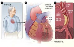 冠心病的起因是什么？