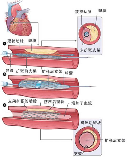 怎樣治療冠心??？(圖2)