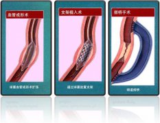 怎樣治療冠心病？