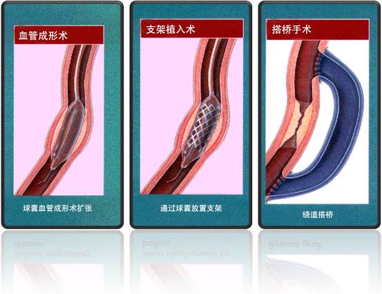 怎樣治療冠心??？(圖1)